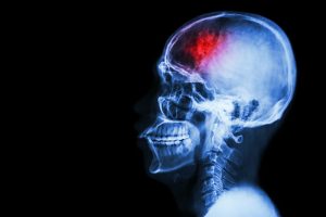 Shift Work Associated with Increased Stroke Severity