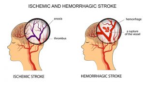 Melatonin and Hemorrhagic Stroke: Supplementation Results in Improved Patient Outcome 3