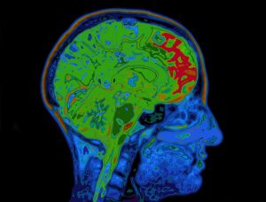 Mri,Image,Of,Head,Showing,Brain