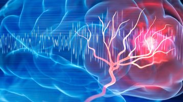 Une étude révèle une forte prévalence de modifications cérébrales cachées chez les personnes souffrant de maladies cardiaques