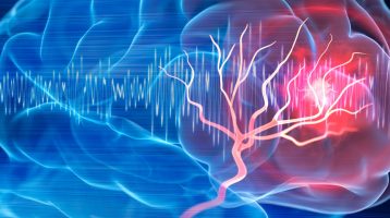 Studie zeigt hohe Prävalenz verborgener Hirnveränderungen bei Menschen mit Herzerkrankungen